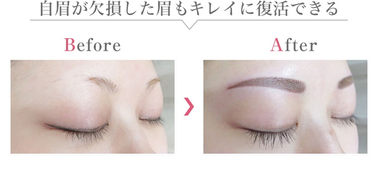 自眉が欠損した眉もキレイに復活できる