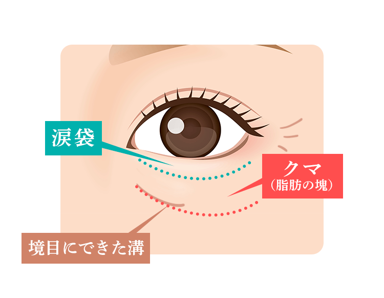 下瞼部のたるみ・クマの原因
