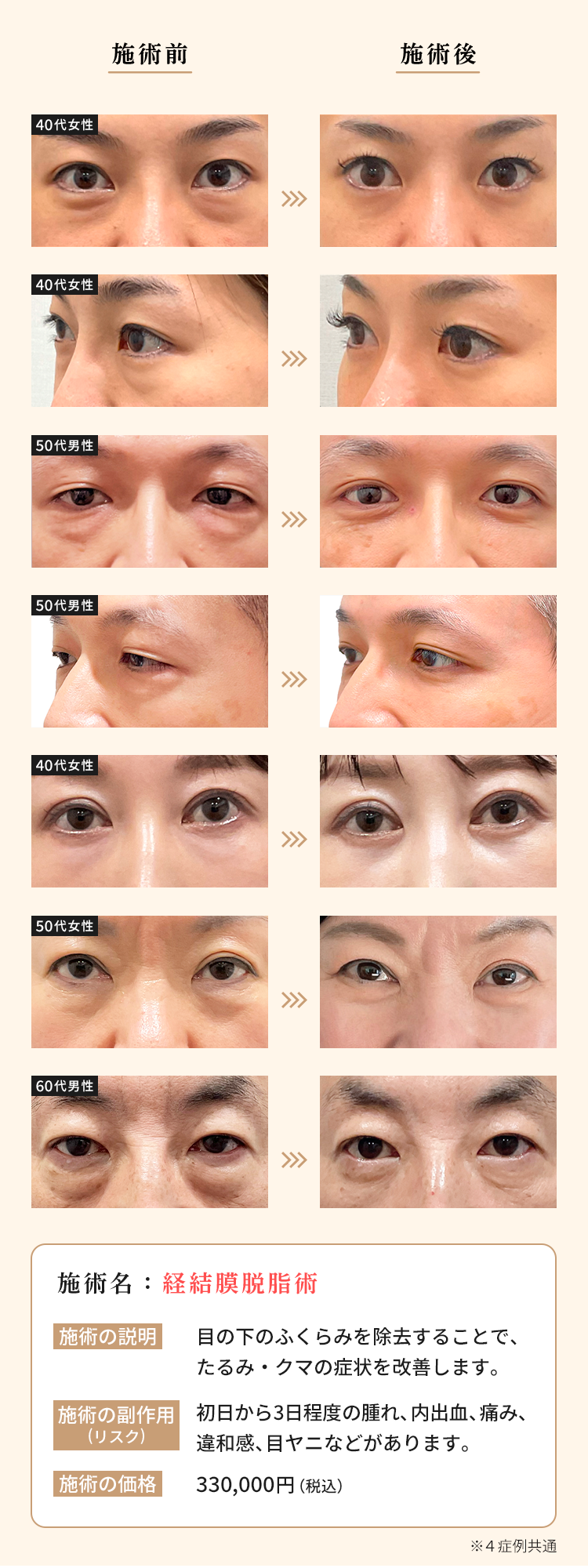 施術名：経結膜脱脂術　施術の説明：目の下のふくらみを除去することで、たるみ・クマの症状を改善します。