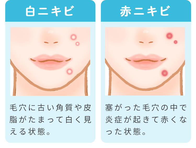 美容皮膚科なら根本をキレイに!おすすめニキビ・毛穴治療 | シロノクリニック