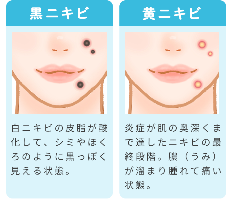 美容皮膚科なら根本をキレイに!おすすめニキビ・毛穴治療 | シロノクリニック