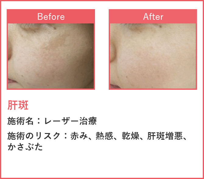 肝斑 レーザー治療