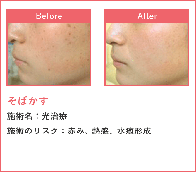 そばかす 光治療