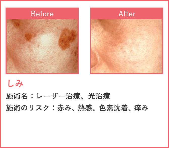 しみ レーザー治療、光治療