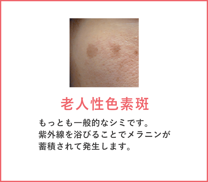 老人性色素斑