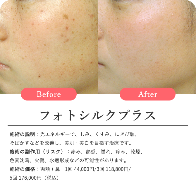 フォトシルクプラス