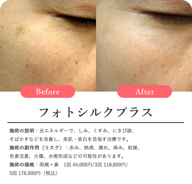 フォトシルクプラス