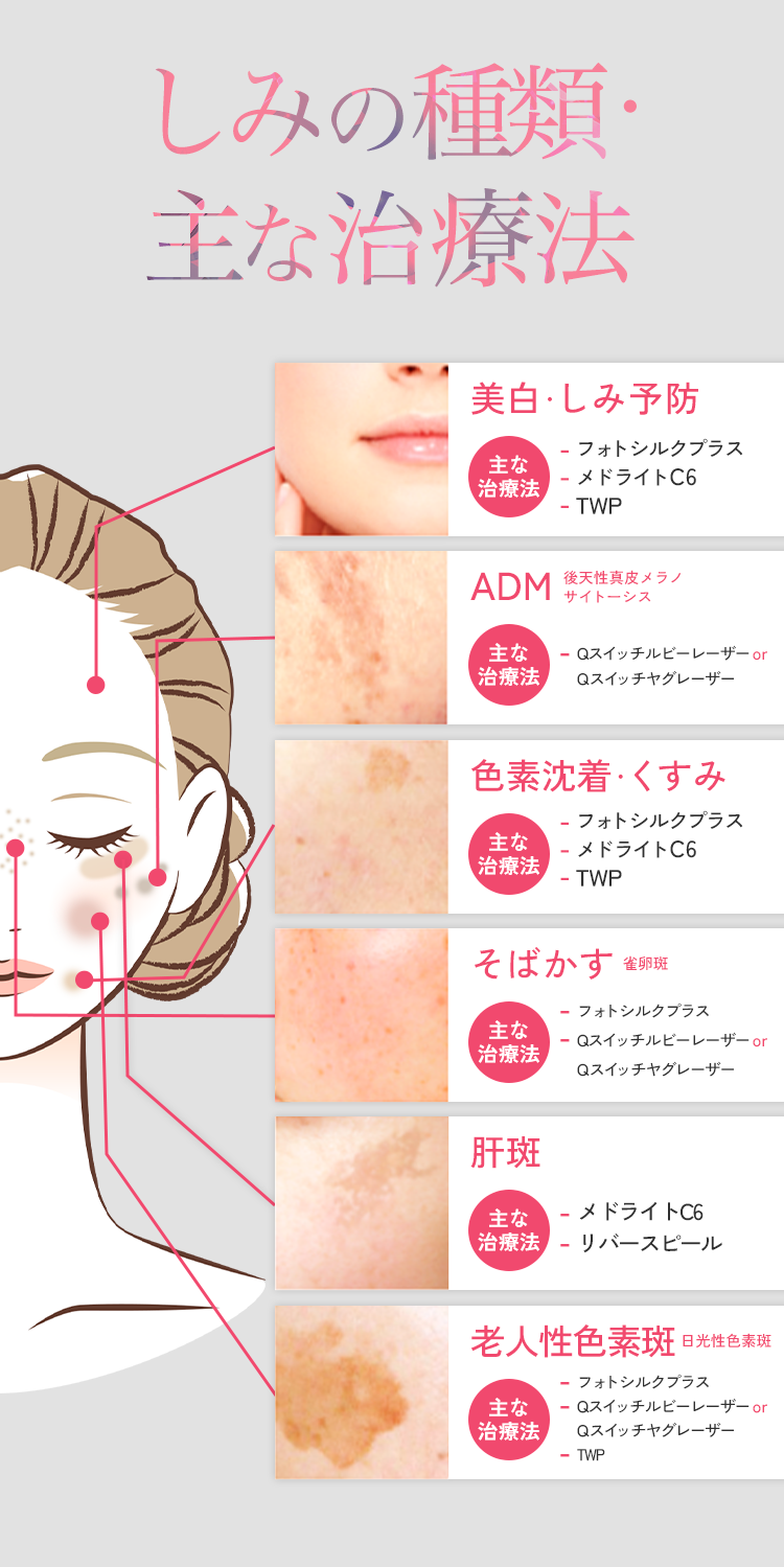 シミの種類・主な治療方法