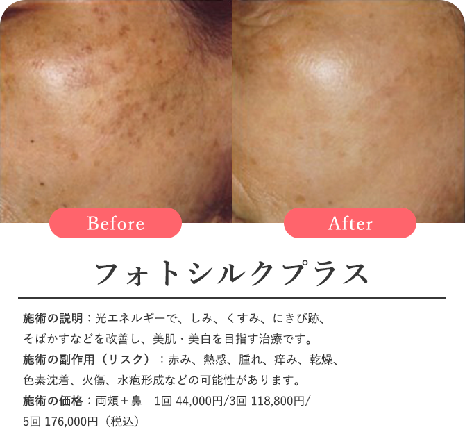 フォトシルクプラス