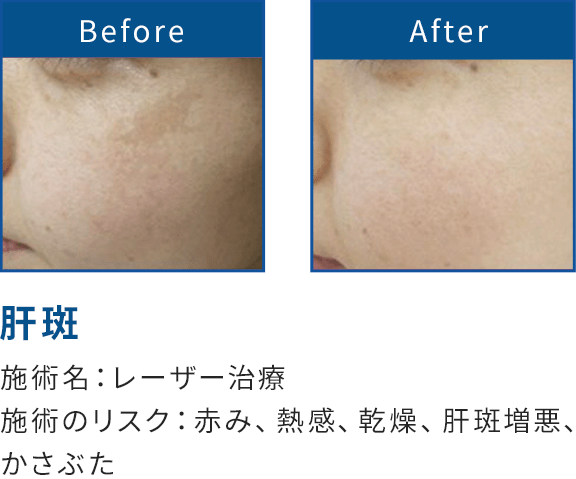 肝斑 レーザー治療