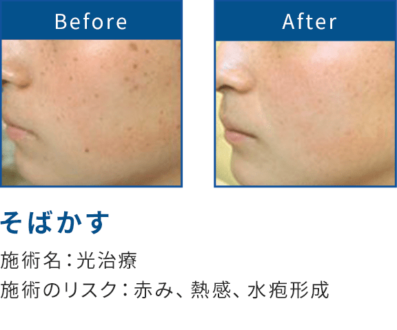 そばかす 光治療