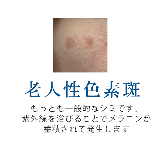 老人性色素沈着