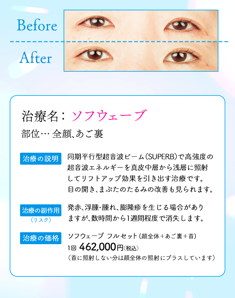 ソフウェーブ