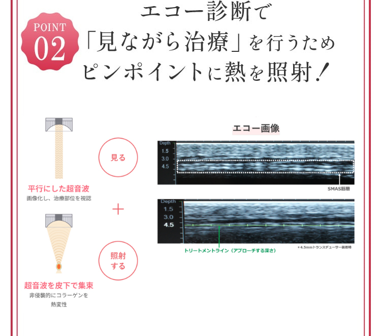 エコー診断で「見ながら治療」を行うためピンポイントに熱を照射！
