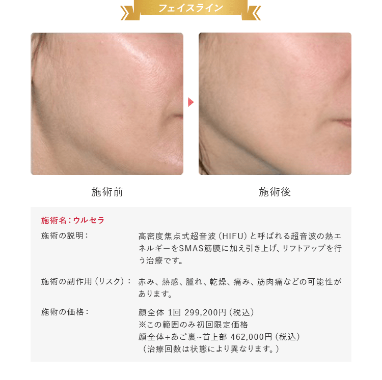 フェイスライン