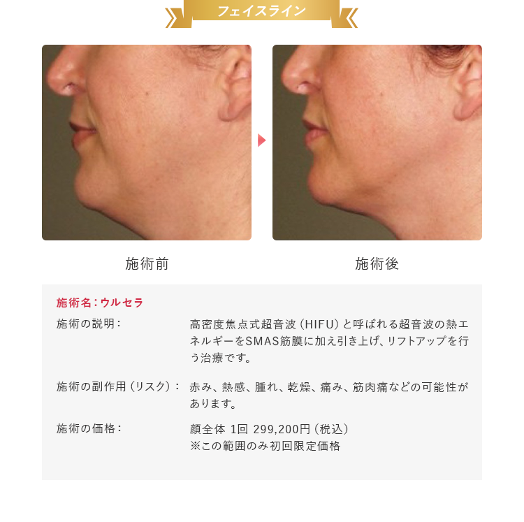 フェイスライン