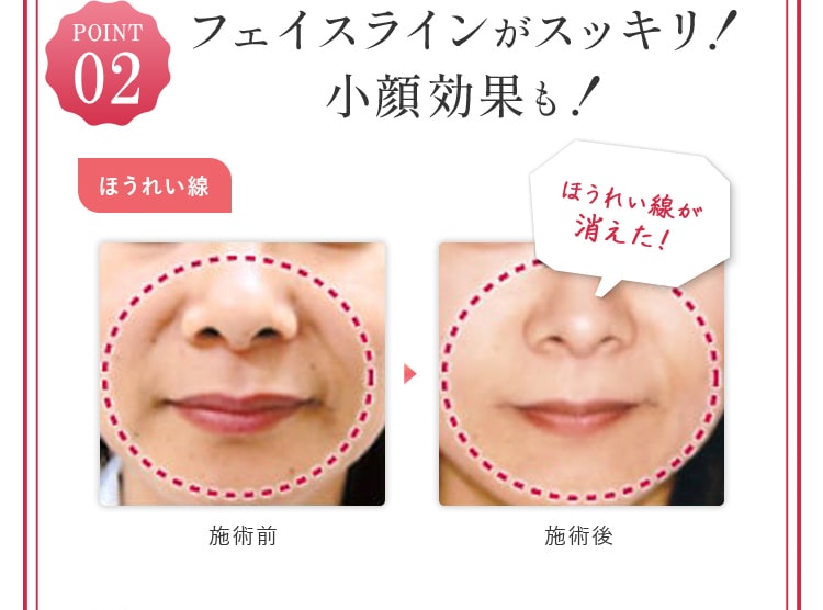フェイスラインがスッキリ！小顔効果も！！
