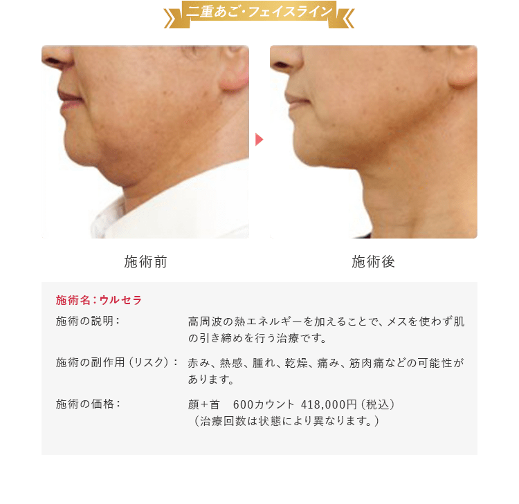二重あご・フェイスライン