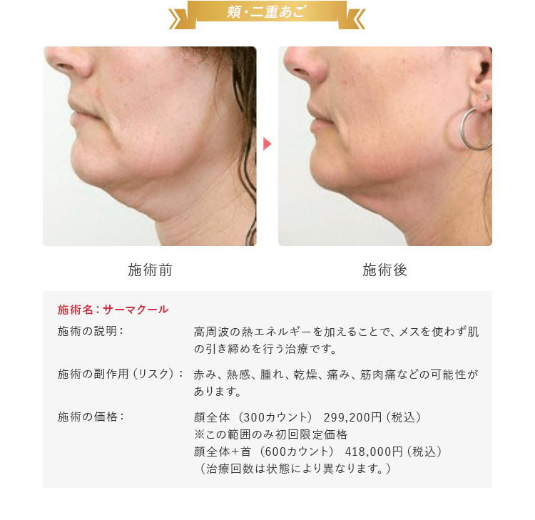 頬・二重あご